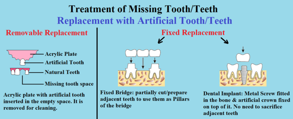 Different ways of teeth replacement