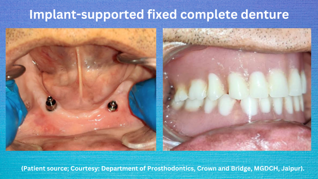 Dental implant-supported denture