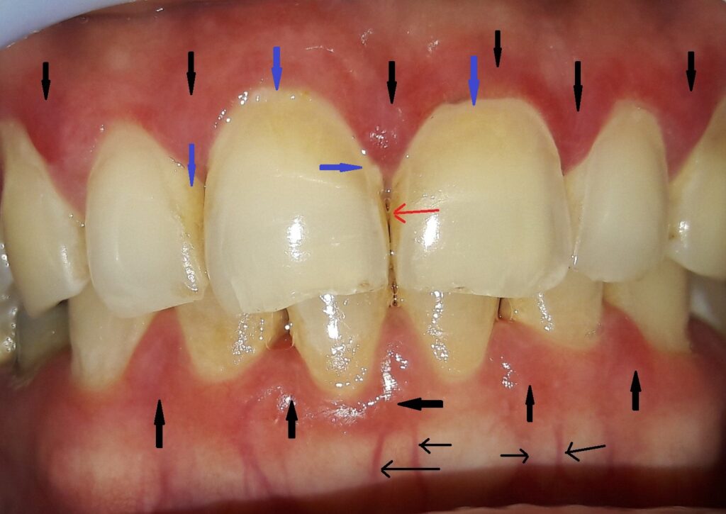 Dental Plaque (blue arrows), tarter (red arrow), inflamed gums (black arrows) and enlarged blood vessels (thin black arrows)