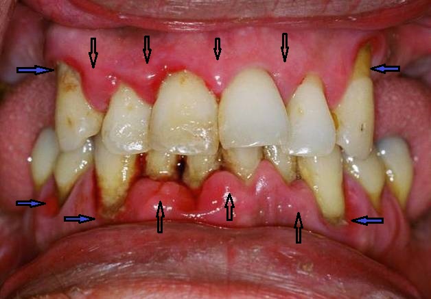 Advance gum disease