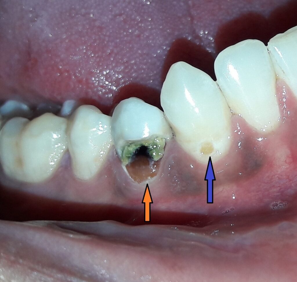 Early and advanced tooth decay.