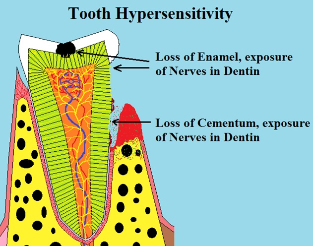 Causes of tooth sensitivity: Damage to the Outer Layer Resulting in Exposure of Underlying Nerves