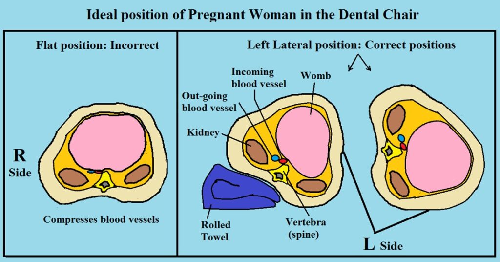 Ideal resting position for pregnant women.