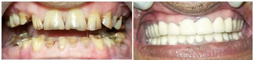 Treatment of severely worn down teeth 