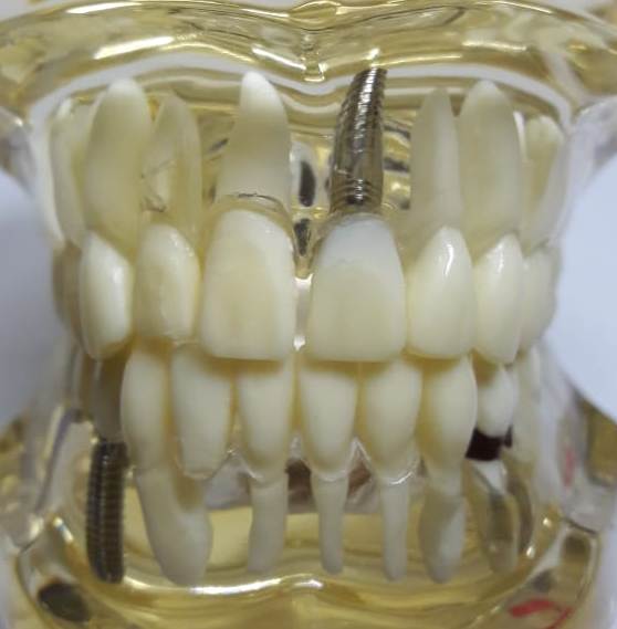 dental implants