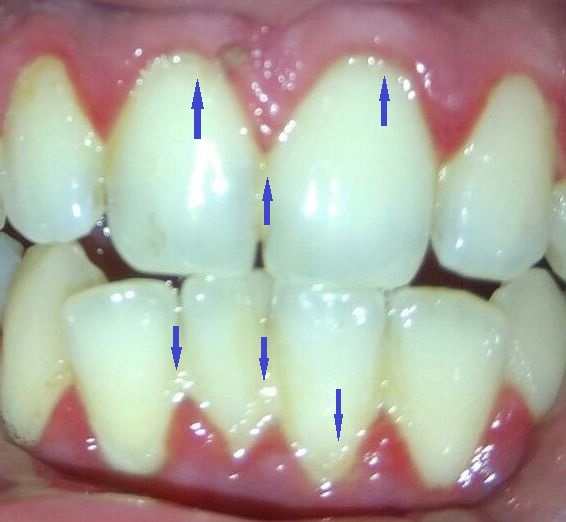 Dental plaque