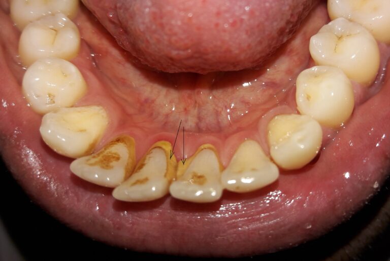 Initial gum disease caused by dental tarter