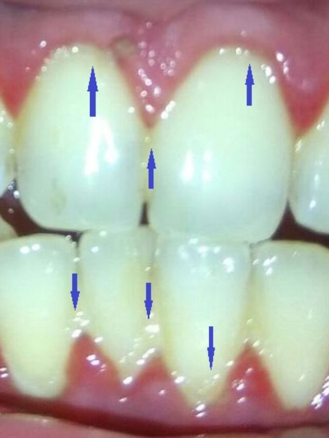 Dental plaque