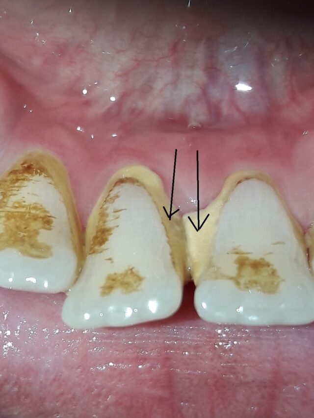 “Uncovering the Hidden Culprit of Gum Disease: Dental Tartar”