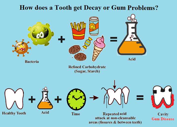 how does tooth decay start?