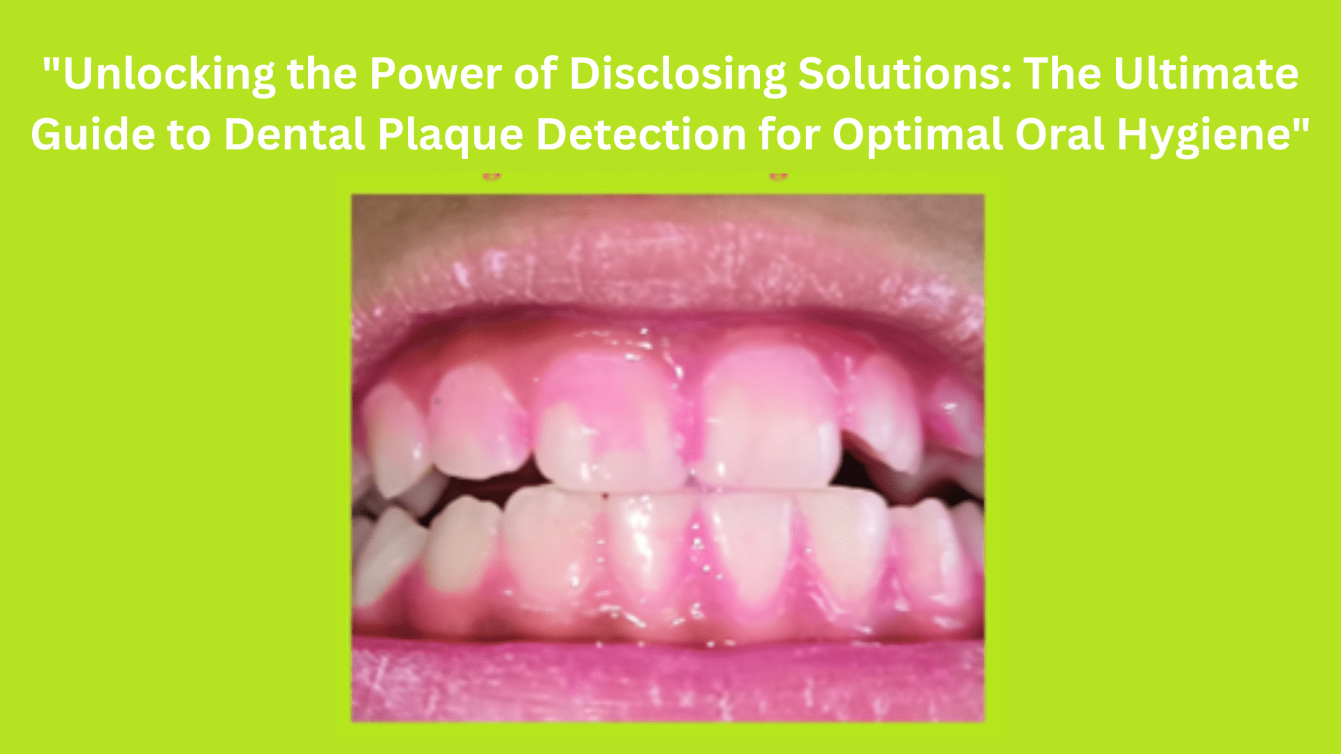 "Unlocking the Power of Plaque Disclosing Solution The Ultimate Guide